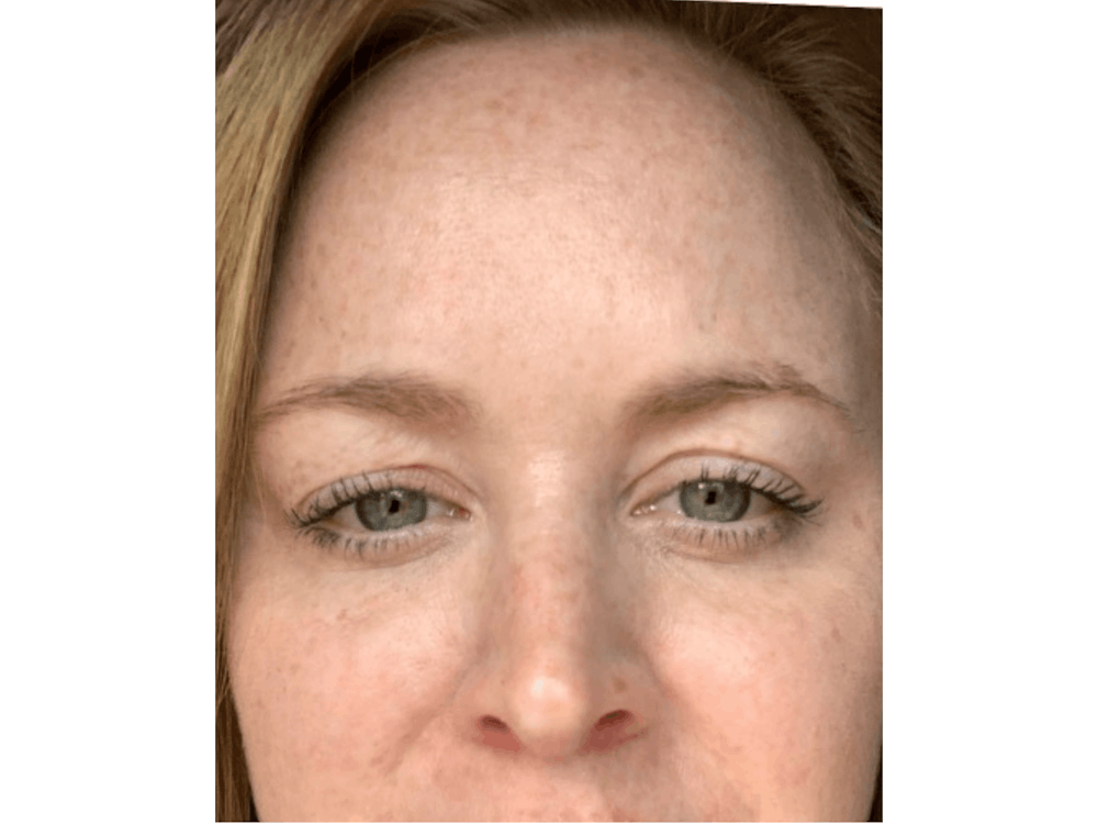 BOTOX  Before & After Gallery - Patient 103403184 - Image 2