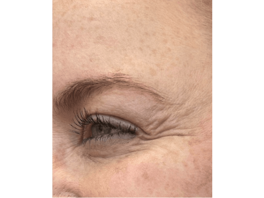 BOTOX  Before & After Gallery - Patient 103403184 - Image 3