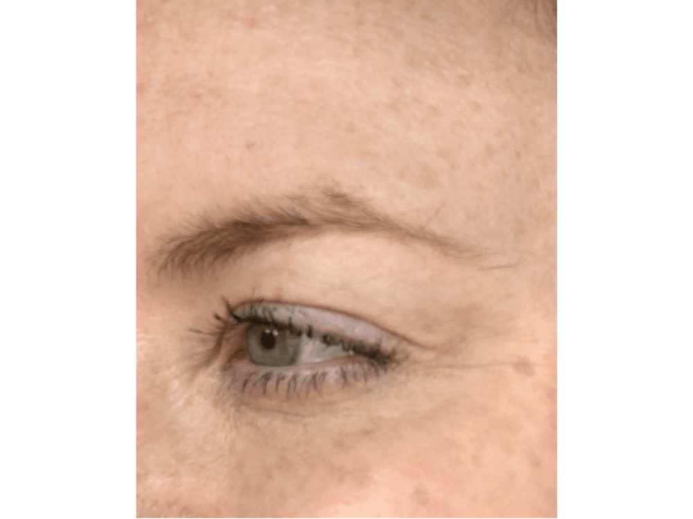 BOTOX  Before & After Gallery - Patient 103403184 - Image 4