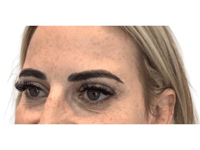 BOTOX  Before & After Gallery - Patient 103403381 - Image 2