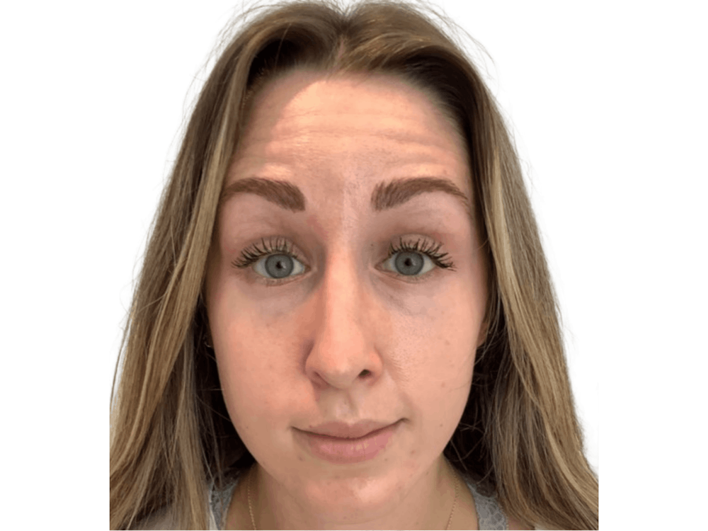 BOTOX  Before & After Gallery - Patient 103403945 - Image 1
