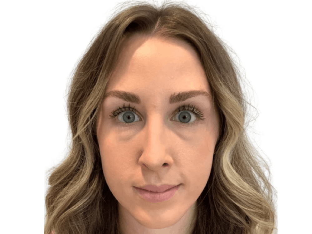 BOTOX  Before & After Gallery - Patient 103403945 - Image 2