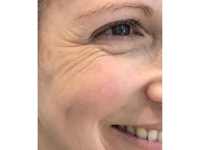 BOTOX  Before & After Gallery - Patient 103404019 - Image 1