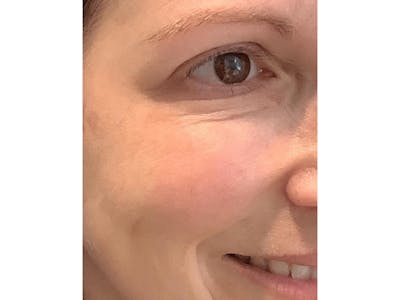 BOTOX  Before & After Gallery - Patient 103404019 - Image 2