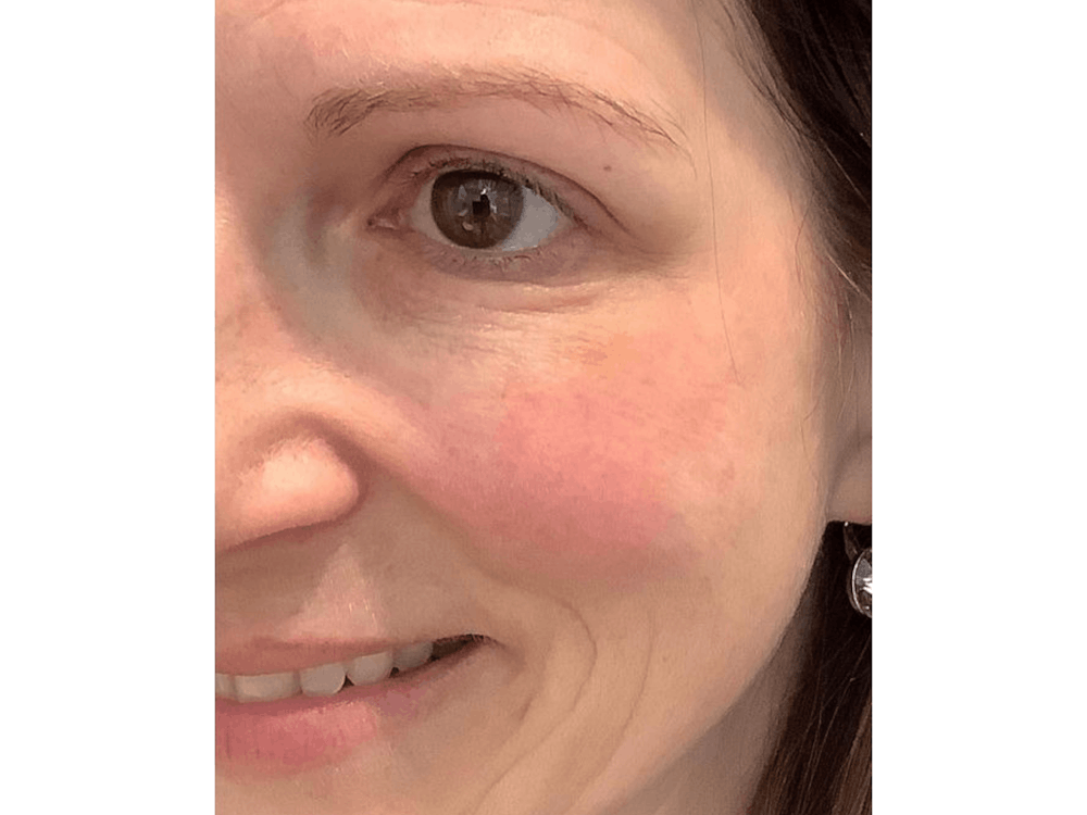 BOTOX  Before & After Gallery - Patient 103404019 - Image 4