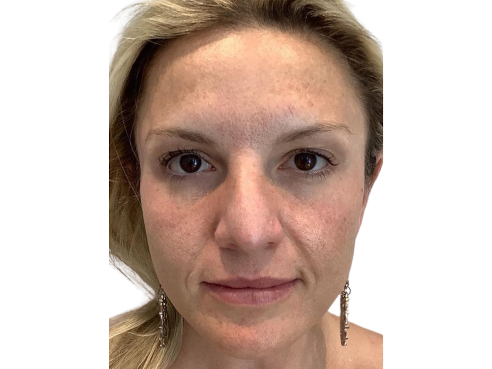 Cheek Filler  Before & After Gallery - Patient 103404317 - Image 1
