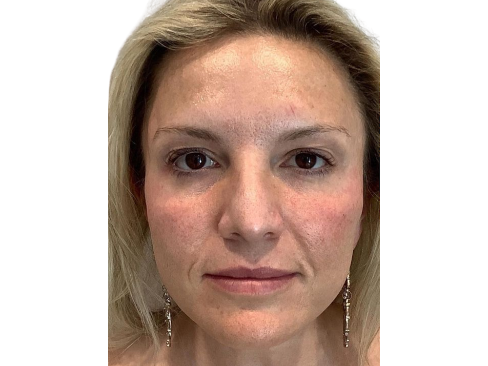 Cheek Filler  Before & After Gallery - Patient 103404317 - Image 2