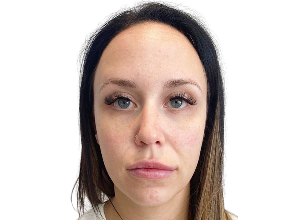 Chin Filler Before & After Gallery - Patient 103404546 - Image 1