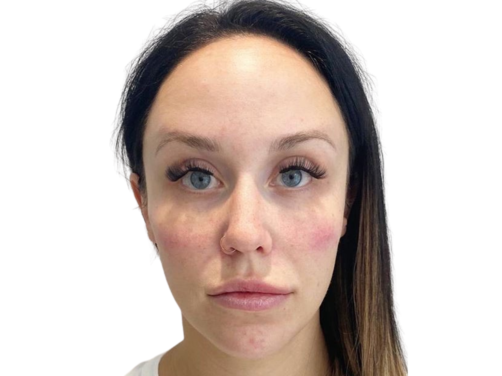 Cheek Filler  Before & After Gallery - Patient 103404319 - Image 2