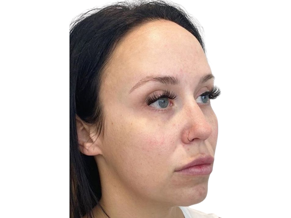 Cheek Filler  Before & After Gallery - Patient 103404319 - Image 3