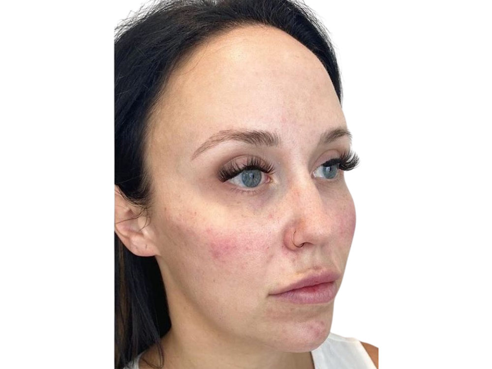 Cheek Filler  Before & After Gallery - Patient 103404319 - Image 4