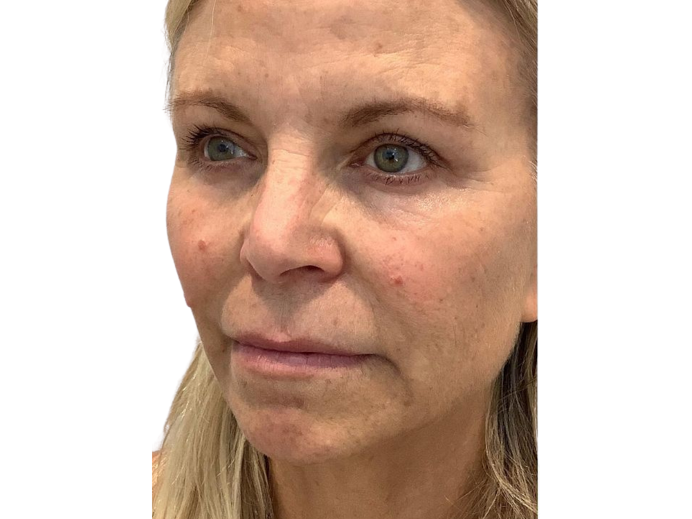 Chin Filler Before & After Gallery - Patient 103404547 - Image 1