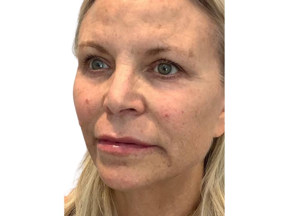 Chin Filler Before & After Gallery - Patient 103404547 - Image 2