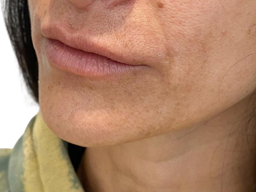 Lip Filler Before & After Gallery - Patient 103404766 - Image 1