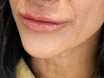 Lip Filler Before & After Gallery - Patient 103404766 - Image 2