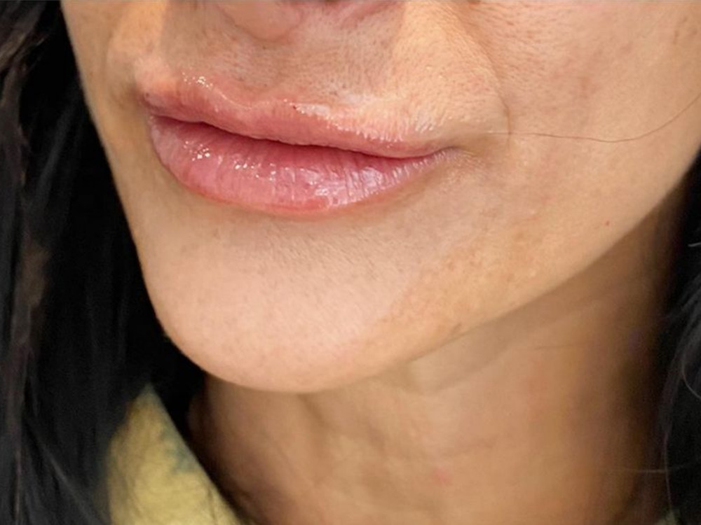 Lip Filler Before & After Gallery - Patient 103404766 - Image 2