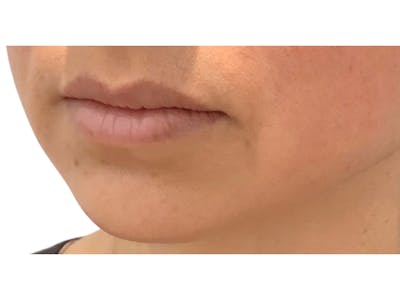 Lip Filler Before & After Gallery - Patient 103404767 - Image 1