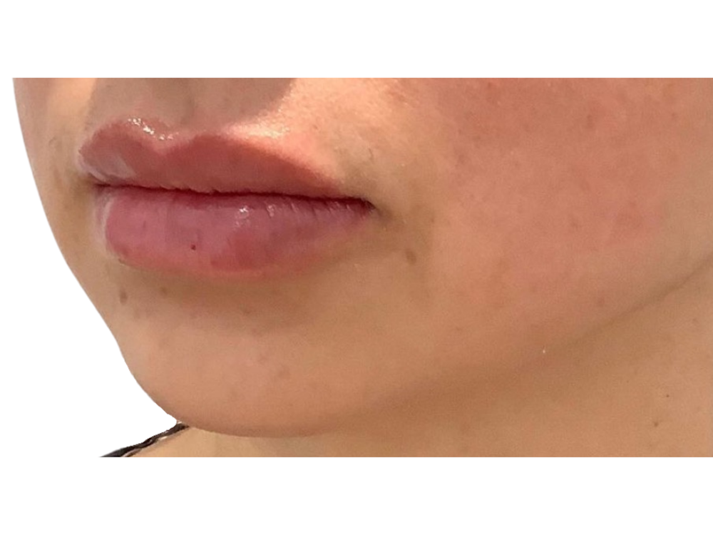 Lip Filler Before & After Gallery - Patient 103404767 - Image 2