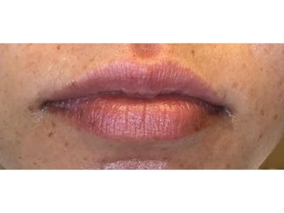 Lip Filler Before & After Gallery - Patient 103404812 - Image 1