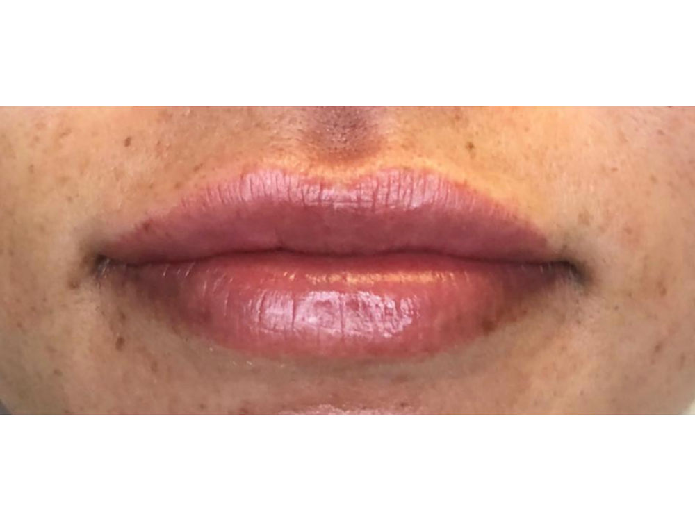 Lip Filler Before & After Gallery - Patient 103404812 - Image 2