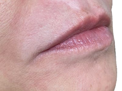 Lip Filler Before & After Gallery - Patient 103404813 - Image 1