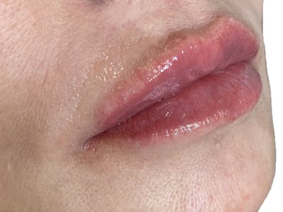 Lip Filler Before & After Gallery - Patient 103404813 - Image 2