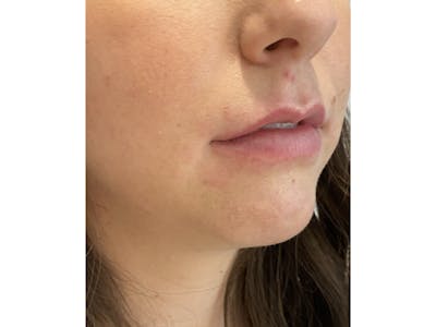 Lip Filler Before & After Gallery - Patient 103404852 - Image 1