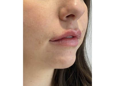 Lip Filler Before & After Gallery - Patient 103404852 - Image 2