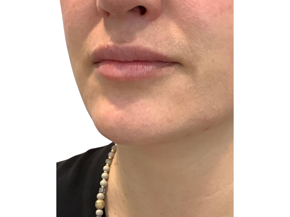 Lip Filler Before & After Gallery - Patient 103404973 - Image 1