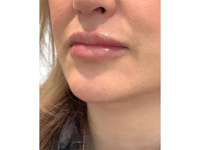 Lip Filler Before & After Gallery - Patient 103404973 - Image 2