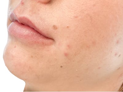 Lip Filler Before & After Gallery - Patient 103404972 - Image 1