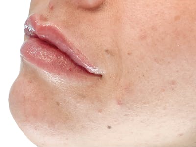Lip Filler Before & After Gallery - Patient 103404972 - Image 2