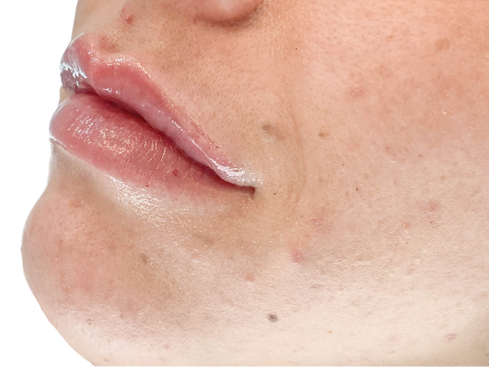 Lip Filler Before & After Gallery - Patient 103404972 - Image 2