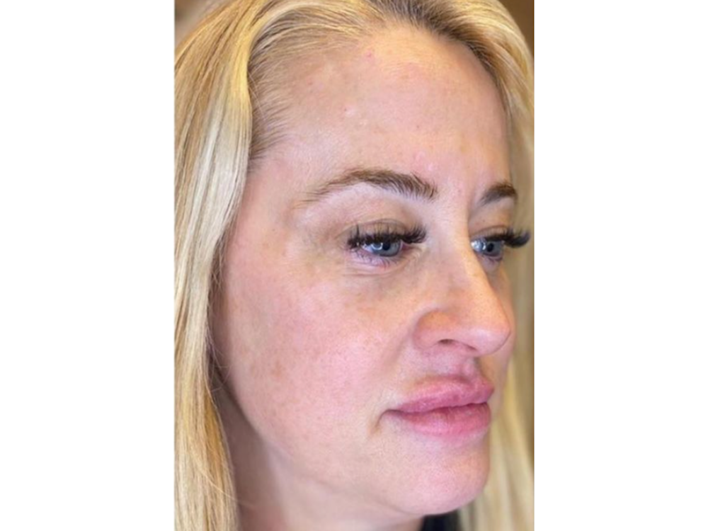 Sculptra Before & After Gallery - Patient 103404995 - Image 1