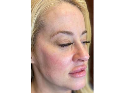 Sculptra Before & After Gallery - Patient 103404995 - Image 2