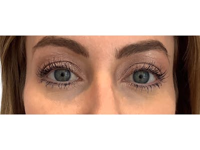 Tear Trough Filler Before & After Gallery - Patient 103405046 - Image 1