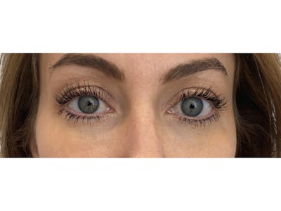 Tear Trough Filler Before & After Gallery - Patient 103405046 - Image 2