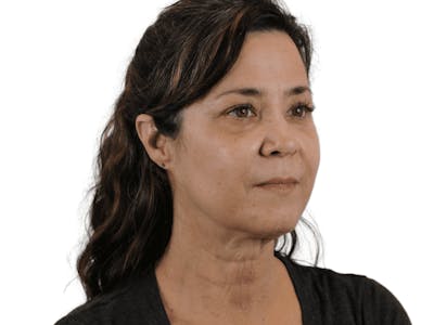 Deep Neck Lift Before & After Gallery - Patient 113523041 - Image 1