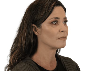 Deep Plane Facelift Before & After Gallery - Patient 113523038 - Image 6