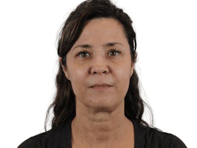 Facelift Before & After Gallery - Patient 113523038 - Image 1