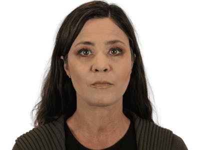 Deep Plane Facelift Before & After Gallery - Patient 113523038 - Image 2
