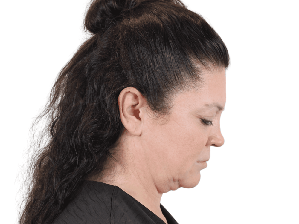 Deep Plane Facelift Before & After Gallery - Patient 113523474 - Image 7