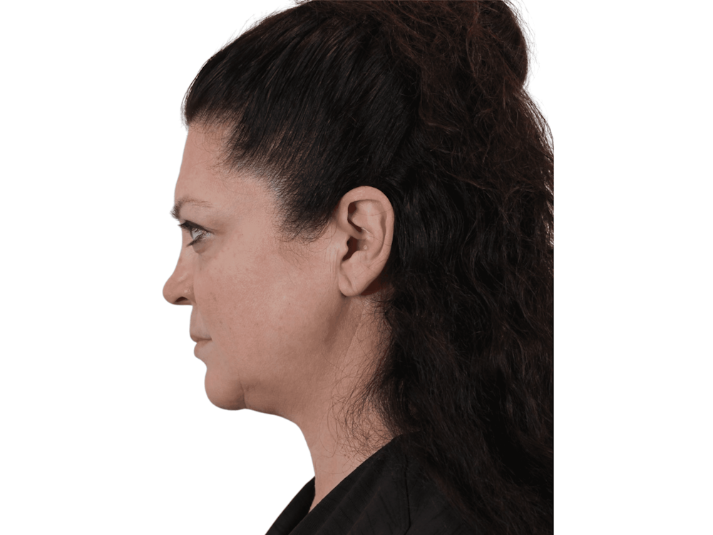 Deep Neck Lift Before & After Gallery - Patient 113523484 - Image 11