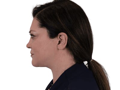 Deep Plane Facelift Before & After Gallery - Patient 113523474 - Image 12