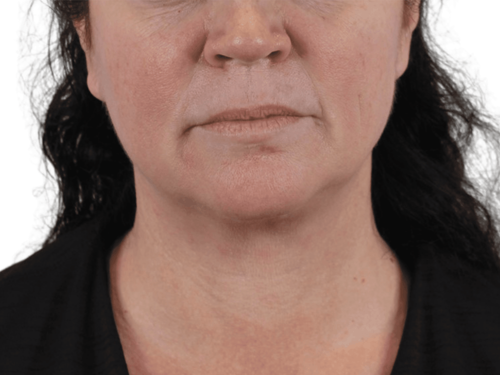 Lip Lift Before & After Gallery - Patient 113523588 - Image 3