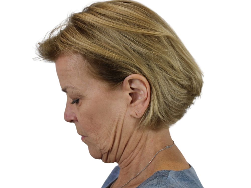 Deep Neck Lift Before & After Gallery - Patient 118972217 - Image 13
