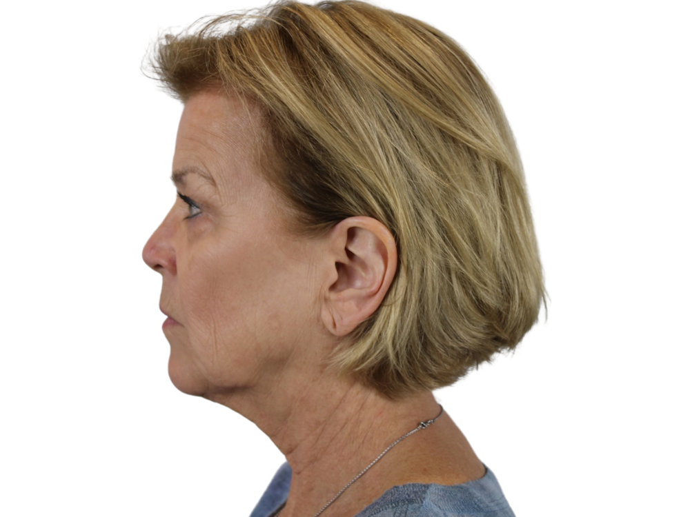 Deep Plane Facelift Before & After Gallery - Patient 118972199 - Image 5