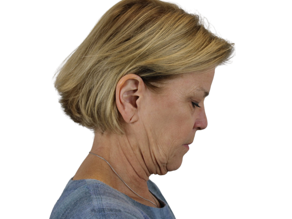 Deep Neck Lift Before & After Gallery - Patient 118972217 - Image 11