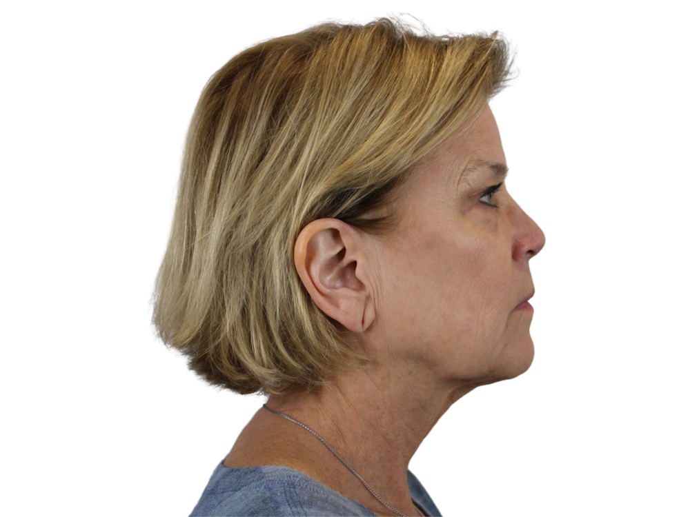 Deep Plane Facelift Before & After Gallery - Patient 118972199 - Image 9