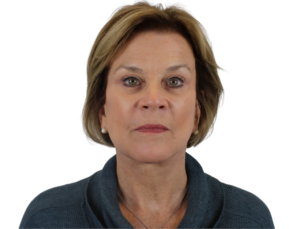 Deep Plane Facelift Before & After Gallery - Patient 118972199 - Image 2